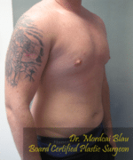 Pseudogynecomastia