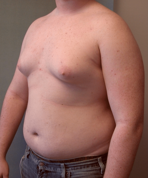 Pseudogynecomastia