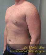 Pseudogynecomastia