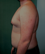 Pseudogynecomastia