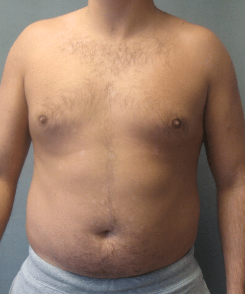 Pseudogynecomastia