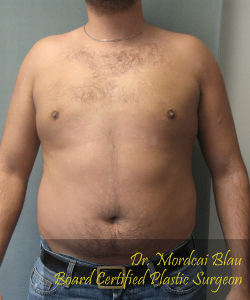 Pseudogynecomastia