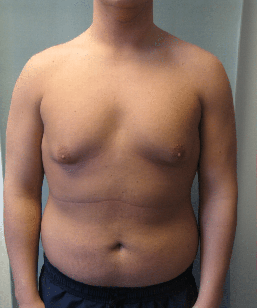 Pseudogynecomastia Before Photo Pseudogynecomastia