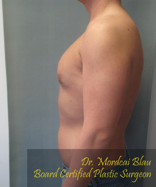 Pseudogynecomastia