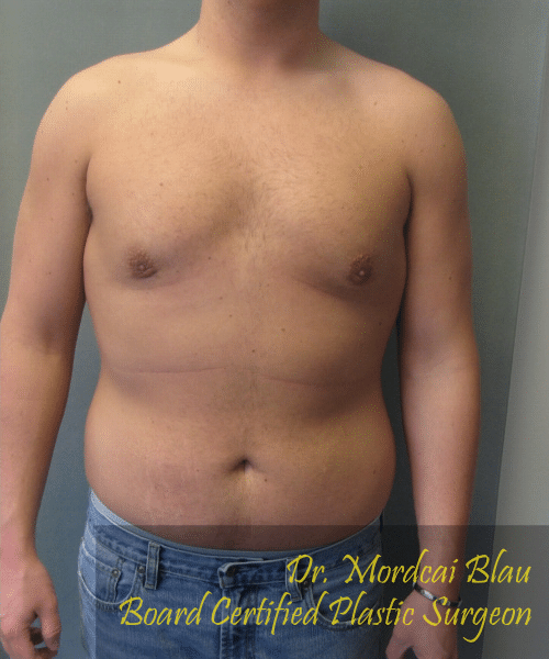 Pseudogynecomastia