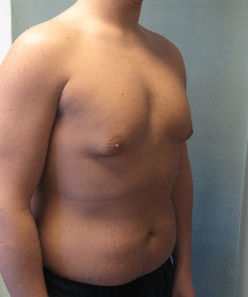 Pseudogynecomastia