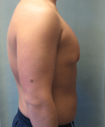 Pseudogynecomastia