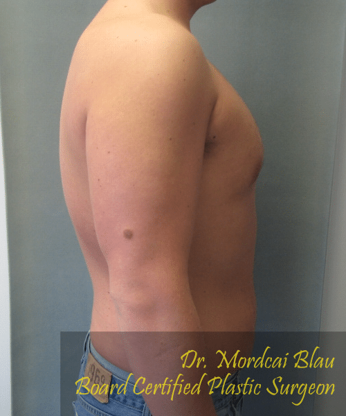 Pseudogynecomastia