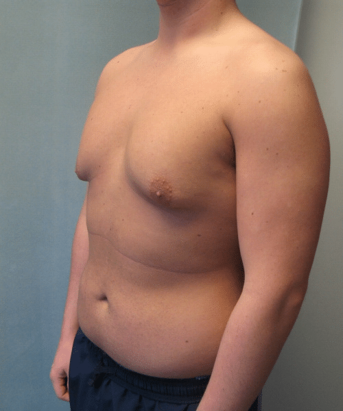 Pseudogynecomastia