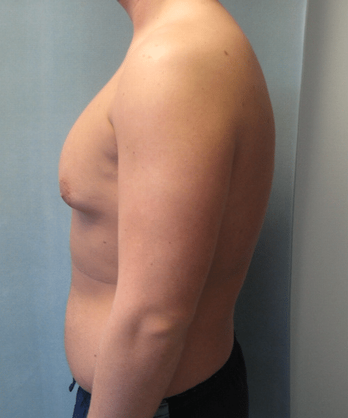 Pseudogynecomastia