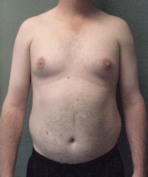 Pseudogynecomastia Before Photo Pseudogynecomastia