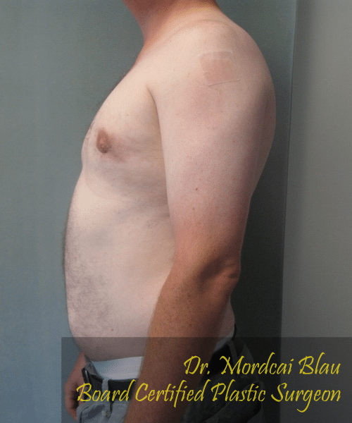 Pseudogynecomastia