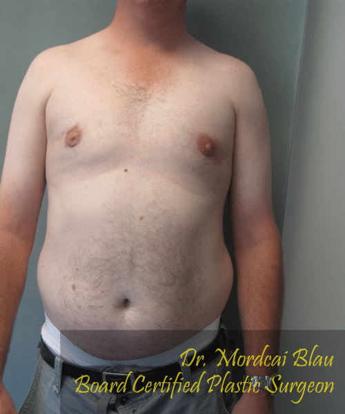 Pseudogynecomastia