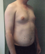 Pseudogynecomastia