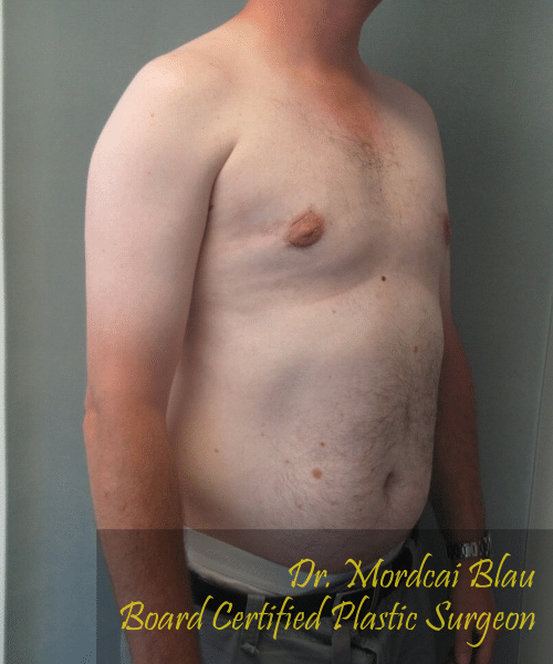 Pseudogynecomastia