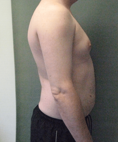 Pseudogynecomastia