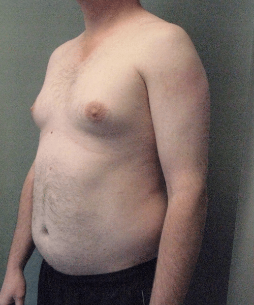 Pseudogynecomastia