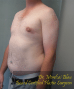 Pseudogynecomastia