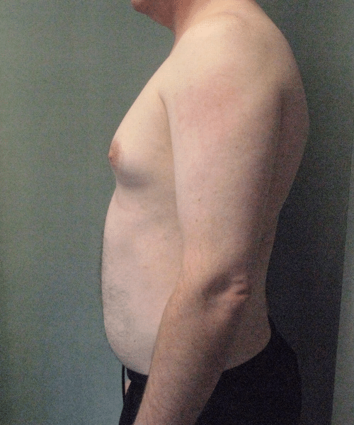 Pseudogynecomastia