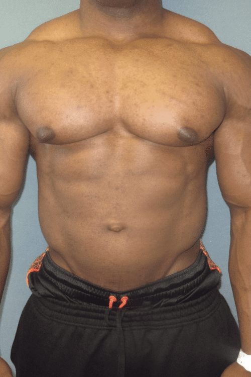 Gynecomastia Surgery for Bodybuilders