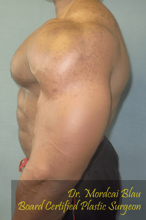 Gynecomastia Surgery for Bodybuilders