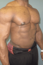 Gynecomastia Surgery for Bodybuilders
