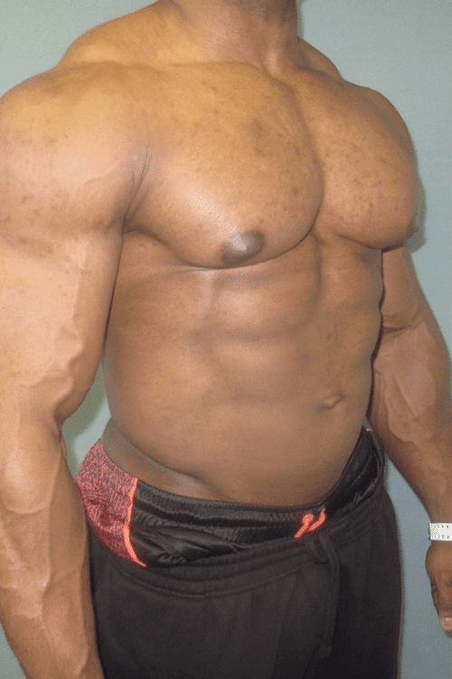 Gynecomastia Surgery for Bodybuilders