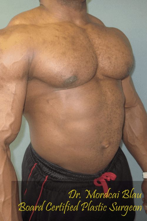 Gynecomastia Surgery for Bodybuilders