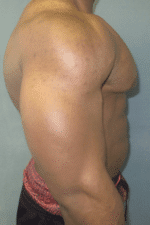 Gynecomastia Surgery for Bodybuilders
