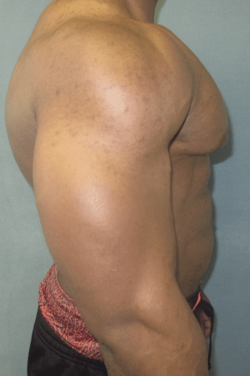 Gynecomastia Surgery for Bodybuilders