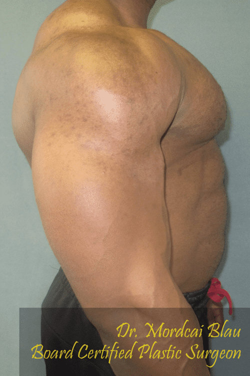 Gynecomastia Surgery for Bodybuilders