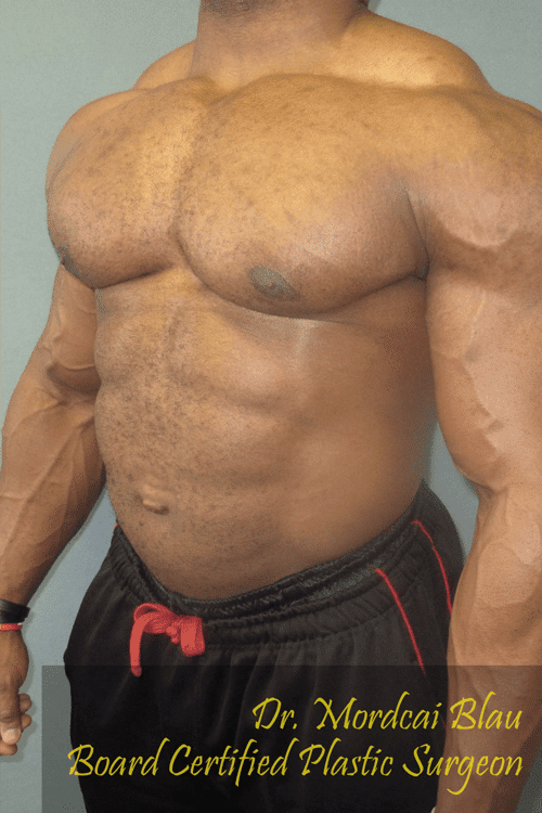 Gynecomastia Surgery for Bodybuilders