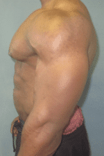 Gynecomastia Surgery for Bodybuilders