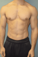 Gynecomastia Surgery for Bodybuilders