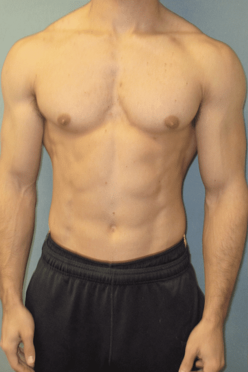 Gynecomastia Surgery for Bodybuilders