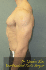 Gynecomastia Surgery for Bodybuilders