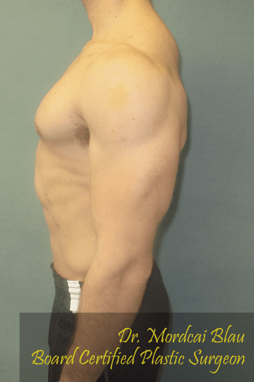 Gynecomastia Surgery for Bodybuilders