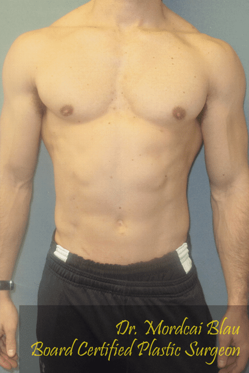 Gynecomastia Surgery for Bodybuilders