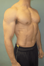 Gynecomastia Surgery for Bodybuilders