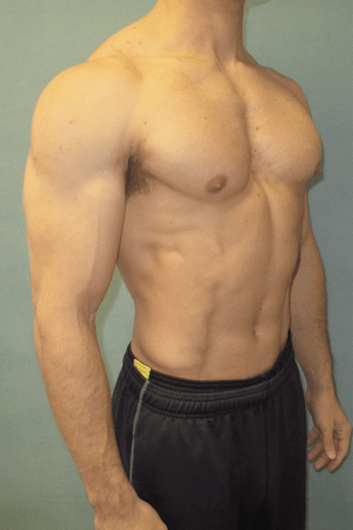 Gynecomastia Surgery for Bodybuilders