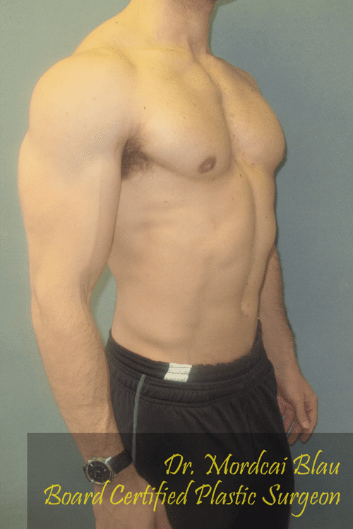 Gynecomastia Surgery for Bodybuilders