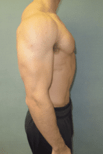 Gynecomastia Surgery for Bodybuilders