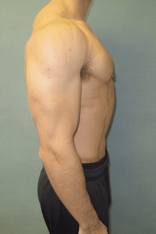 Gynecomastia Surgery for Bodybuilders