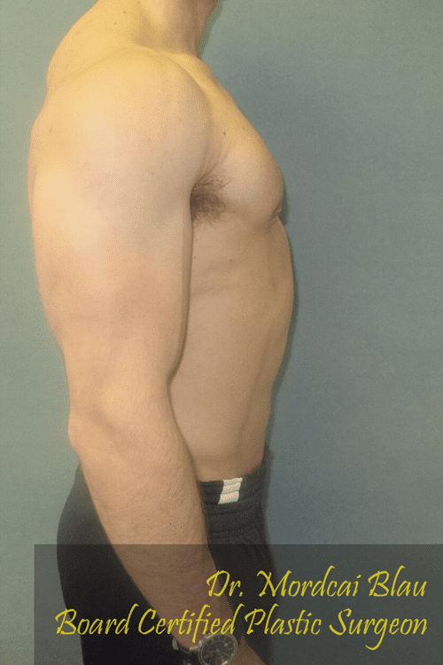 Gynecomastia Surgery for Bodybuilders