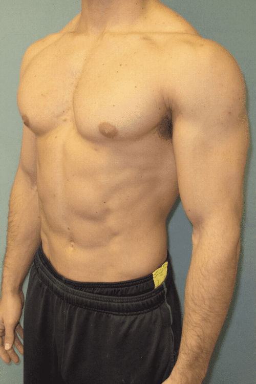 Gynecomastia Surgery for Bodybuilders