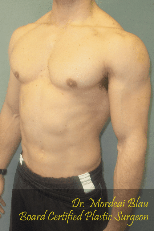 Gynecomastia Surgery for Bodybuilders