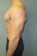 Gynecomastia Surgery for Bodybuilders