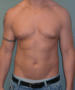 Gynecomastia Surgery for Bodybuilders