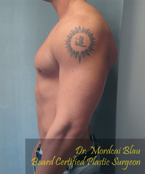 Gynecomastia Surgery for Bodybuilders