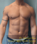 Gynecomastia Surgery for Bodybuilders